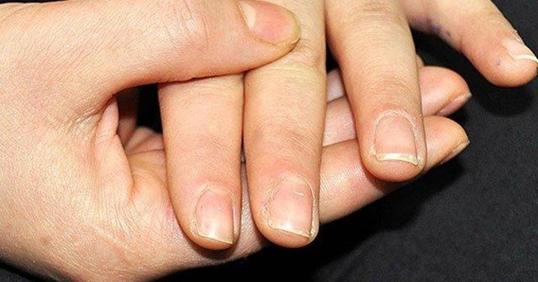 Tırnaklarınız kanseri tespit edebilir! Nasıl mı? ➤ haberion.com
