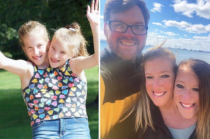 Yapışık İkizler Artık Birlikte Değil – Bir Göz Atın ➤ haberion.com