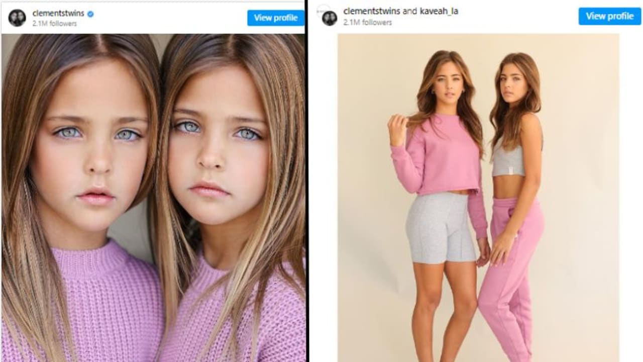 “En Güzel İkizler” Büyüdü – Bugün Hayatlarına Bakın! ➤ haberion.com